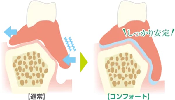 外科手術不要がっちり固定され安定して外れにくい