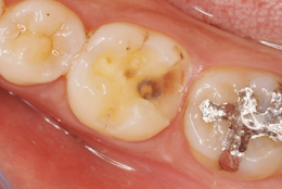 e.max治療術前