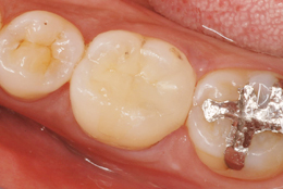 e.max治療術後