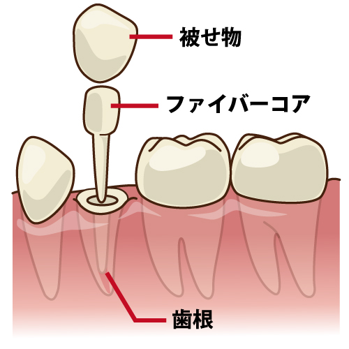 ファイバーコアの利点