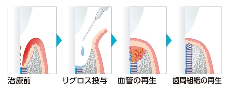 リグロスの歯周組織再生療法の流れ