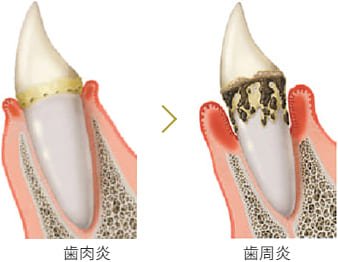 自覚症状がほとんどない