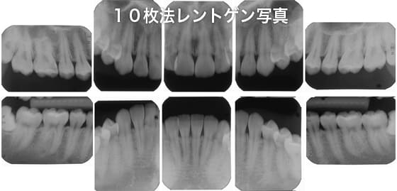 レントゲン10枚法